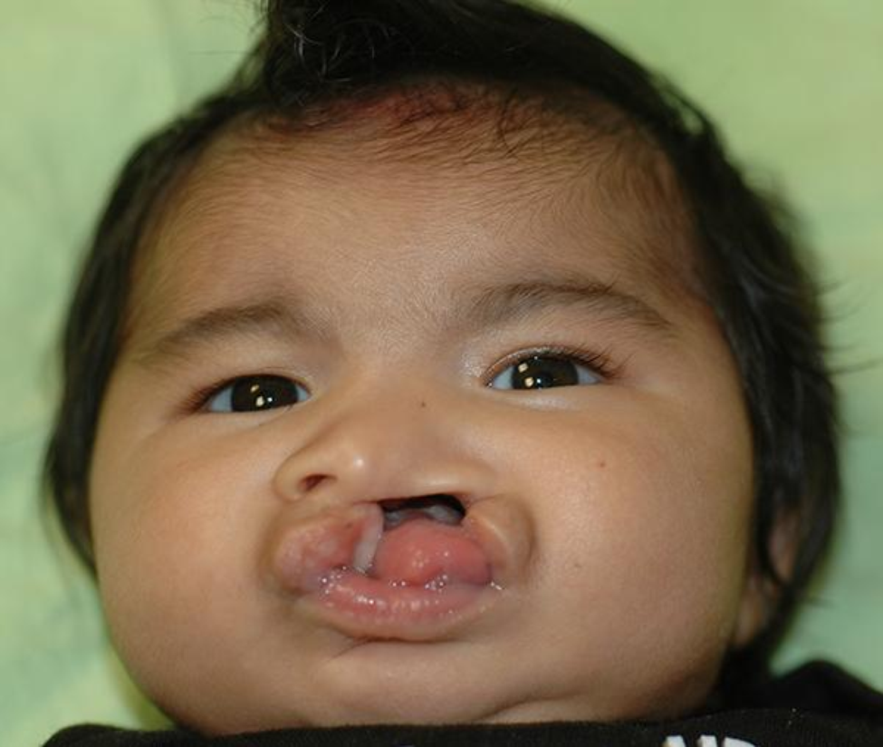 By the time Jae was about 3 months old, he needed surgery to repair his cleft lip. (Photo courtesy of Matthew Greives, MD)